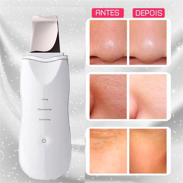 Peeling Ultrassônico Anti Cravos Acne Limpeza Pele Portátil